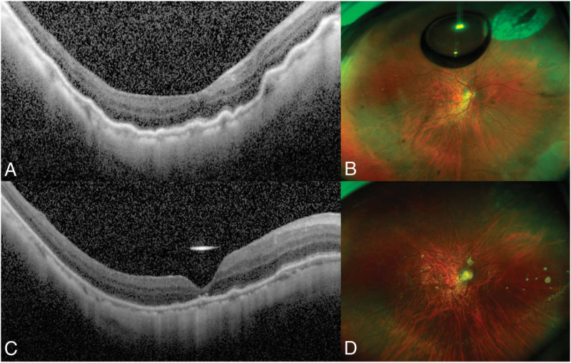 vitrectomy_and_complete_drainage_of_suprachoroidal.bmp